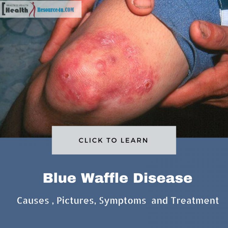 Blue Waffle Disease