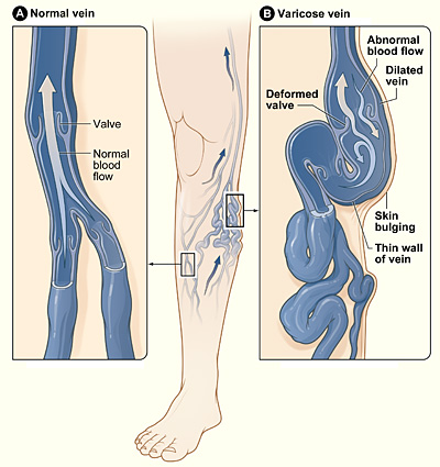 Varicose veins pictures