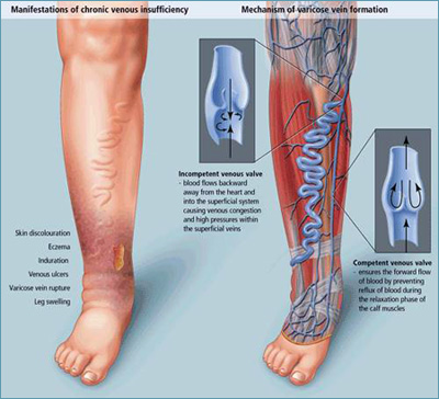 varicose veins pictures