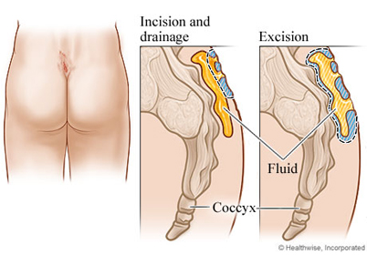 Pilonidal Incision and Drainage