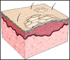 Plaque Scales