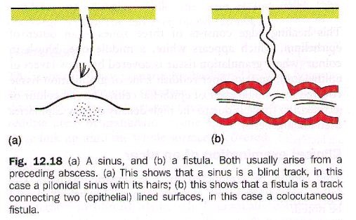 Sinus Tract