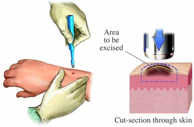 Skin Biopsy