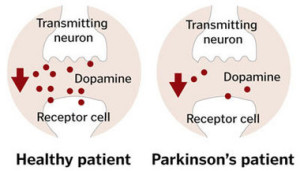 Dopamine levels in Parkinson’s disease