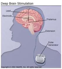 Parkinson’s Surgery