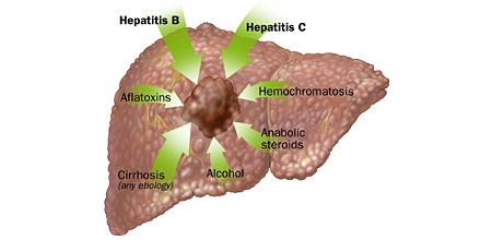 Causes of Liver Pain