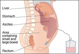 Draining Fluid Near The Liver