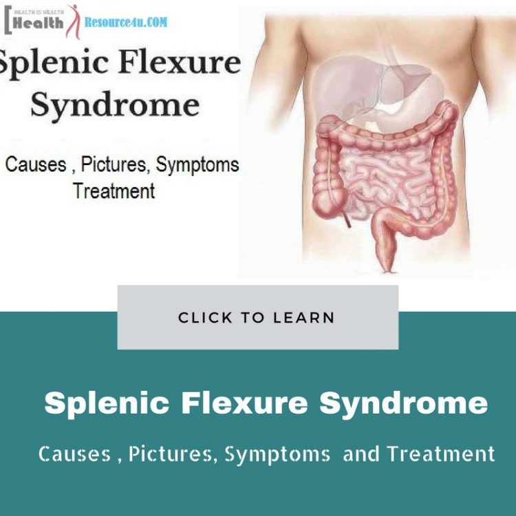 Splenic Flexure Syndrome