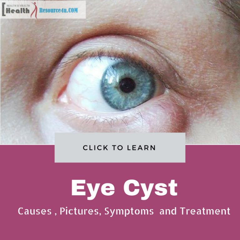 Eye Cyst Causes and treatment