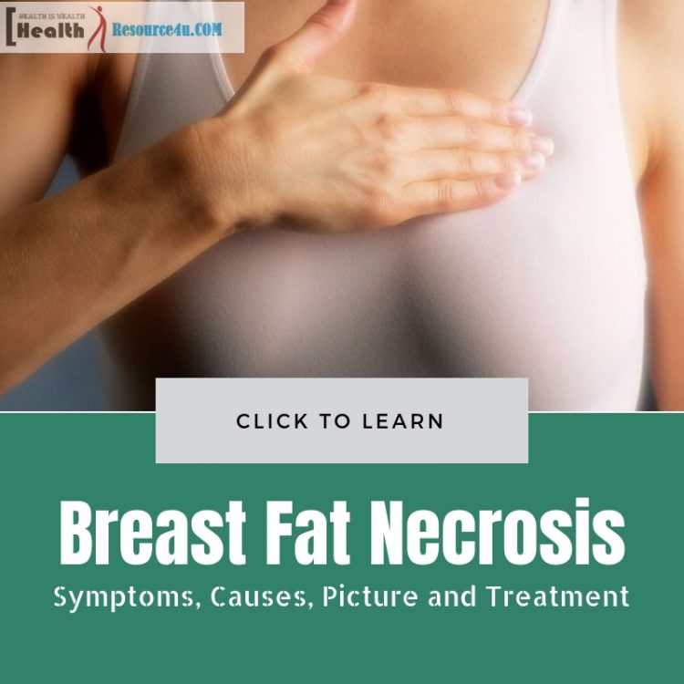 Breast Fat Necrosis