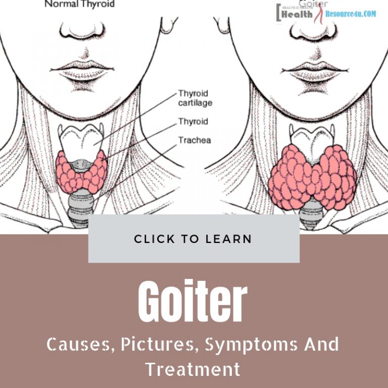 Goiter Pictures