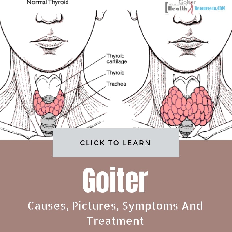 Collection 96+ Images photos of goiter in neck Completed