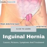 Inguinal Hernia