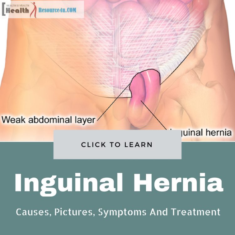 Inguinal Hernia