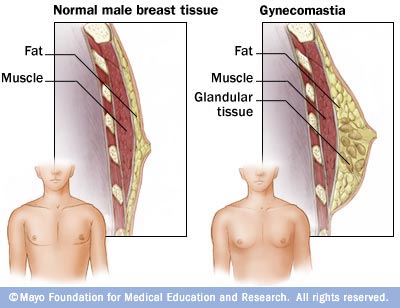 Gynecomastia cure