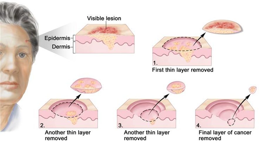 mohs surgery step by step