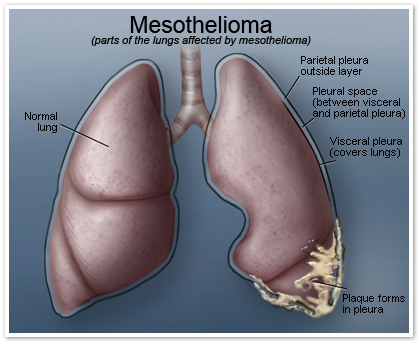 Mesothelioma Prognosis Mesothelioma Prognosis
