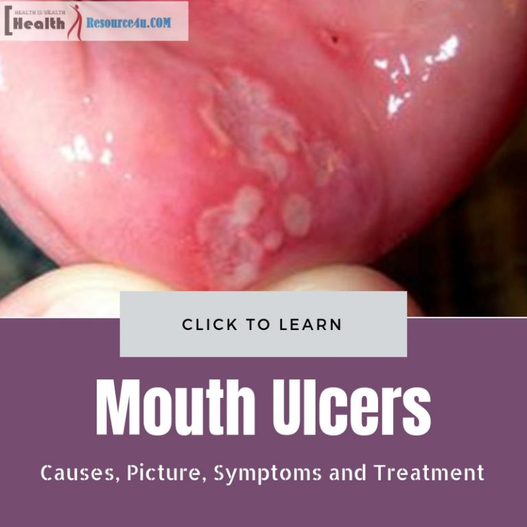 Mouth Ulcers