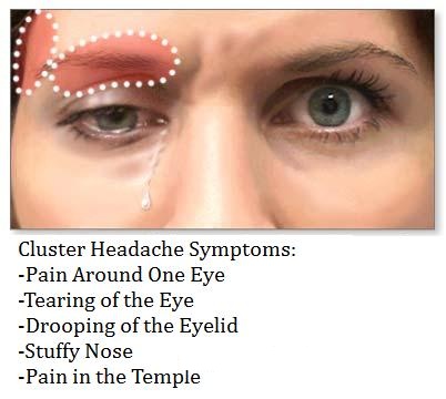 Cluster Headache sysmptoms