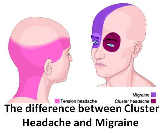 Cluster Headache vs. Migraine