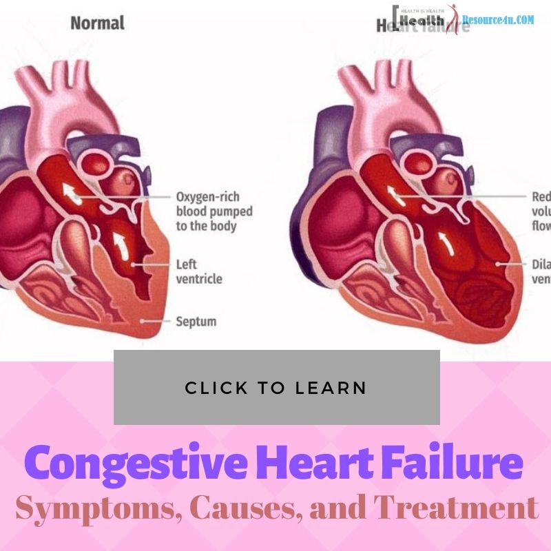 Congestive Heart Failure