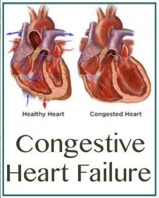 congestive symptoms causes cardiac edema nursing positivemed