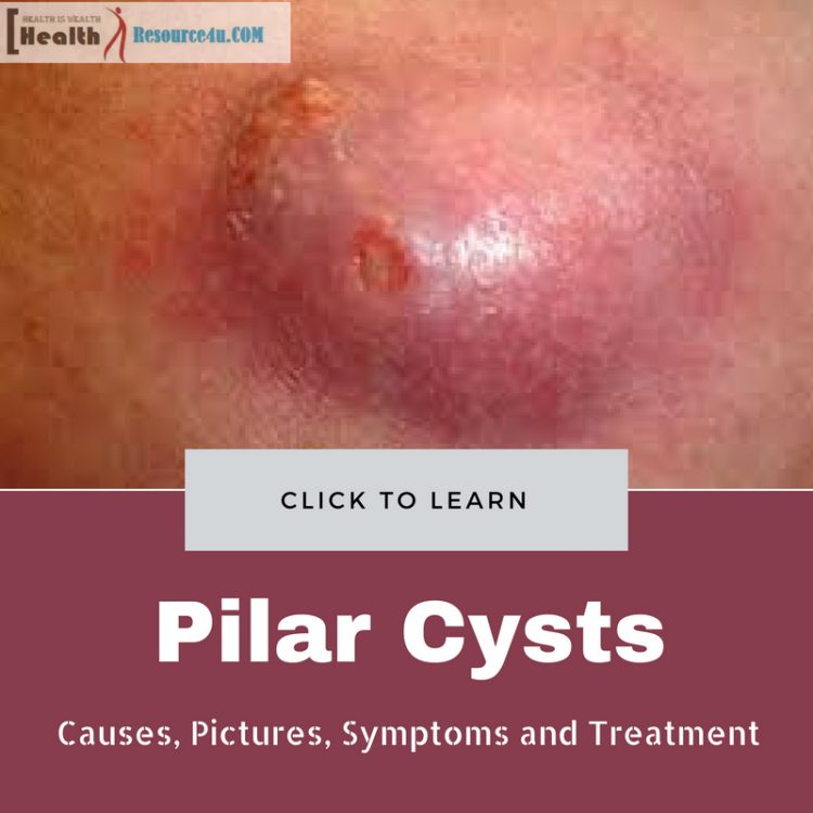 Pilar Cysts Causes Treatment