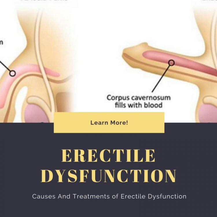 Causes And Treatments of Erectile Dysfunction