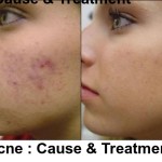 Acne Cause Treatment