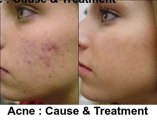 Acne Cause Treatment