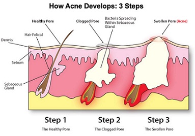 How acne develops