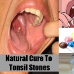 Natural Cure To Tonsil Stones