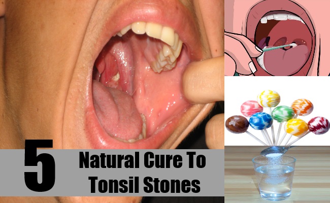 Natural Cure To Tonsil Stones