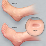 Pitting Edema