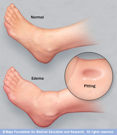 Pitting Edema