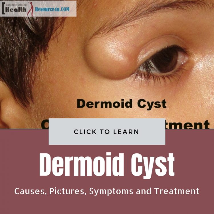 Dermoid Cyst Picture