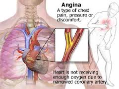 Angina Pectoris