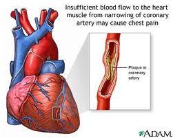 Blockage in the Arteries to the Heart