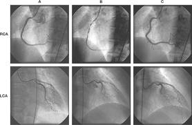 Picture of Angioplasty