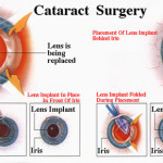 cataract-surgery