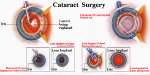 Cataract Surgery: Procedure, Safety, Recovery, Effect