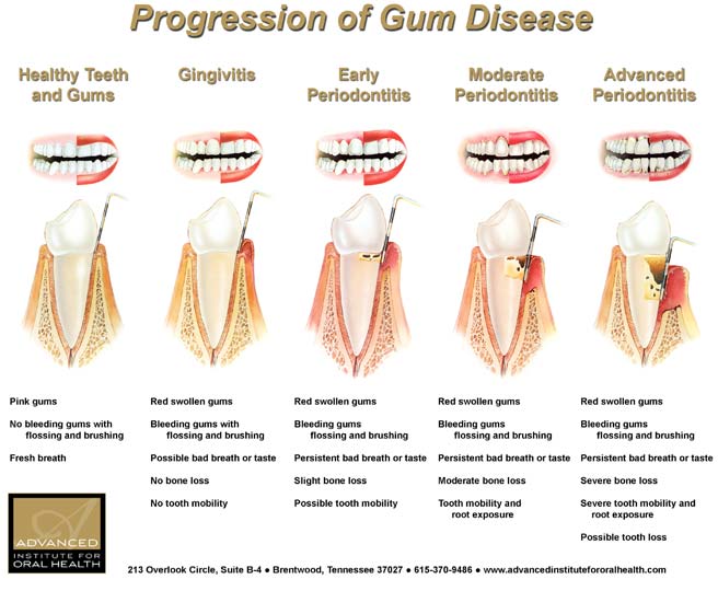 progression of gum disease