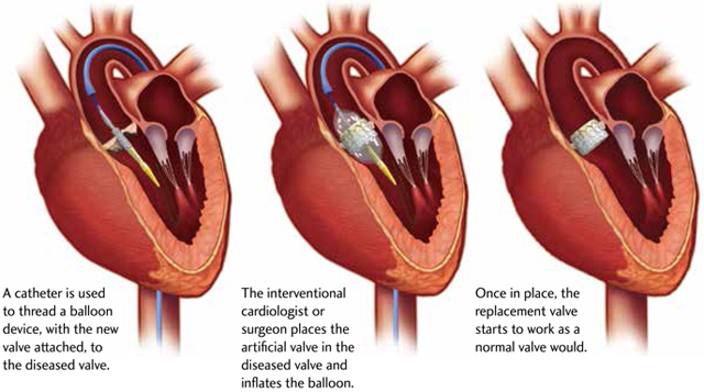 heart valve replacement surgery procedure