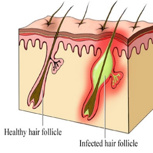 Folliculitis