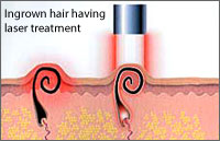 Laser Treatment for Folliculitis