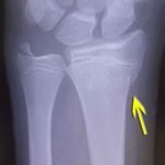 Buckle Fracture