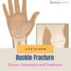 Buckle Fracture causes treatment