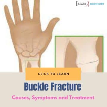 Buckle Fracture causes treatment