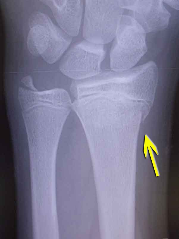 Buckle Fracture