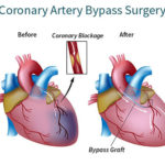 Coronary-Artery-Bypass-Graft-Surgery